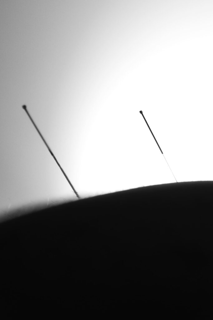 Acupuncture is now available at the The Body Folk.